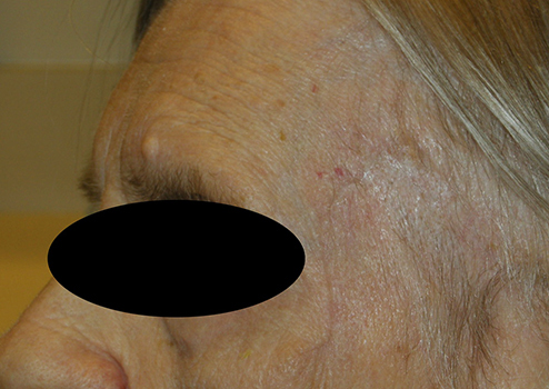 Mohs Surgery - Colorado Dermatology Mohs Surgery