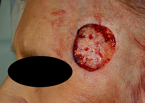 Denver Mohs Surgery cosmetic-left-temple-before