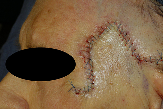 Mohs Surgeon in Denver