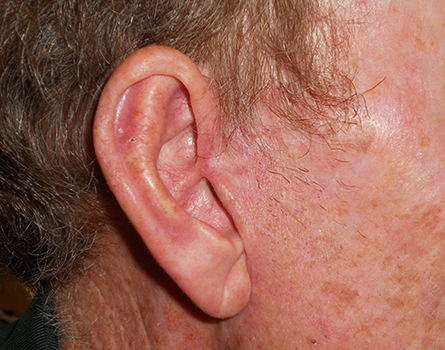 cosmetic-preauricular-after cosmetic-preauricular-after