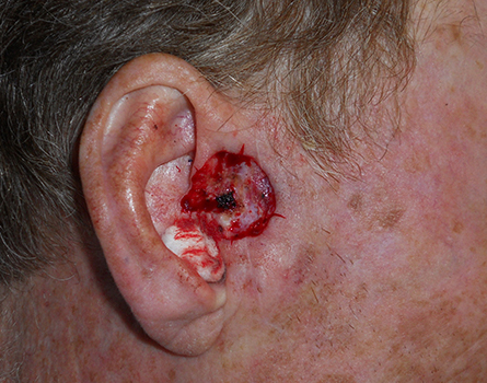 cosmetic-preauricular-defect cosmetic-preauricular-defect