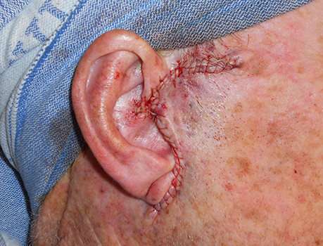 cosmetic-preauricular-sutured cosmetic-preauricular-sutured