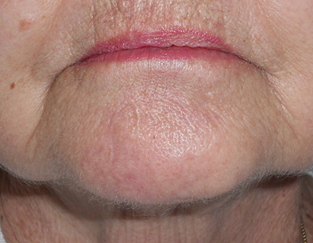 reconstruction-chin-after
