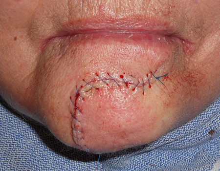 reconstruction-chin-sutured