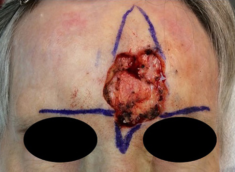 reconstruction-forehead-defect