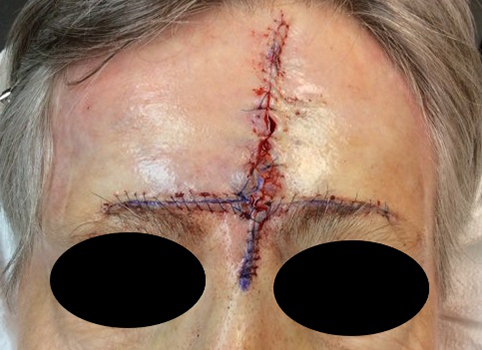 reconstruction-forehead-sutured