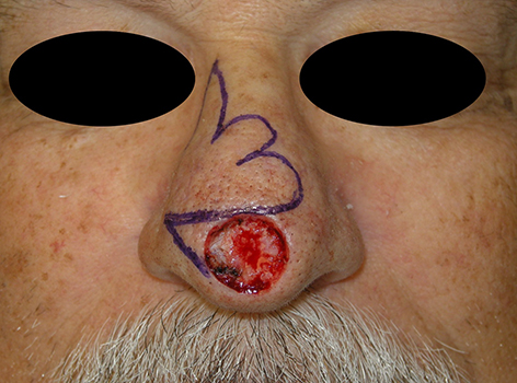 reconstruction-nose-trilobed-defect
