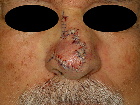 reconstruction-nose-trilobed-sutured