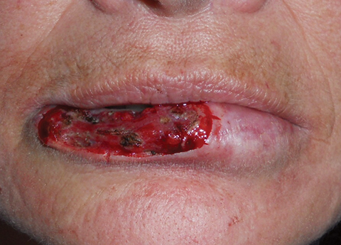lip-defect