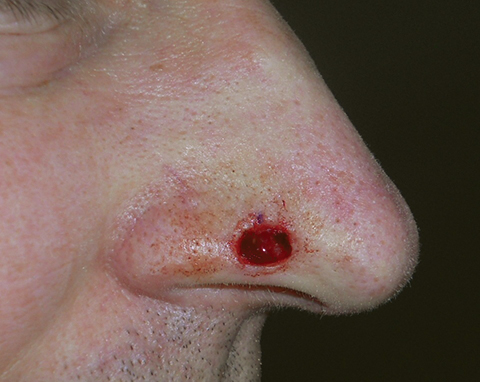 nose-side-defect