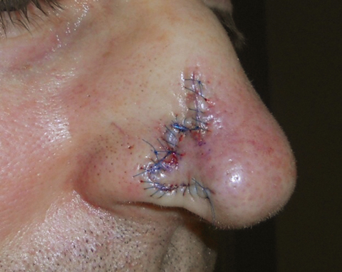 nose-side-repair