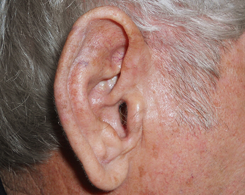 upper-ear-02-followup upper-ear-02-followup